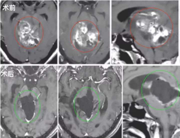 胶质瘤四级从开始就是四级吗,胶质瘤二级会不会升三级