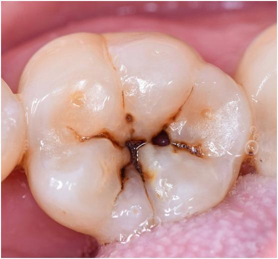牙医使用的钻头型号,牙医的钻头都是什么作用