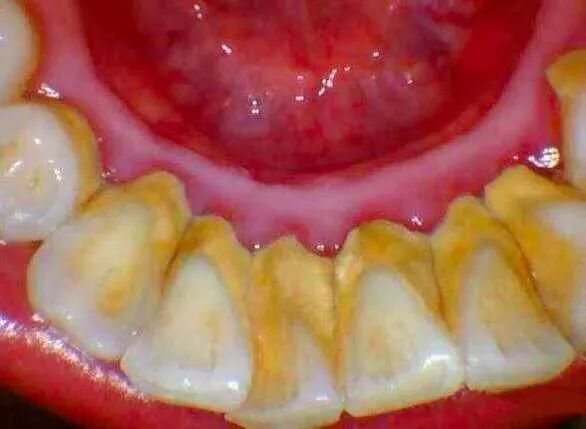 中国人老掉牙,中国人为什么老爱掉牙