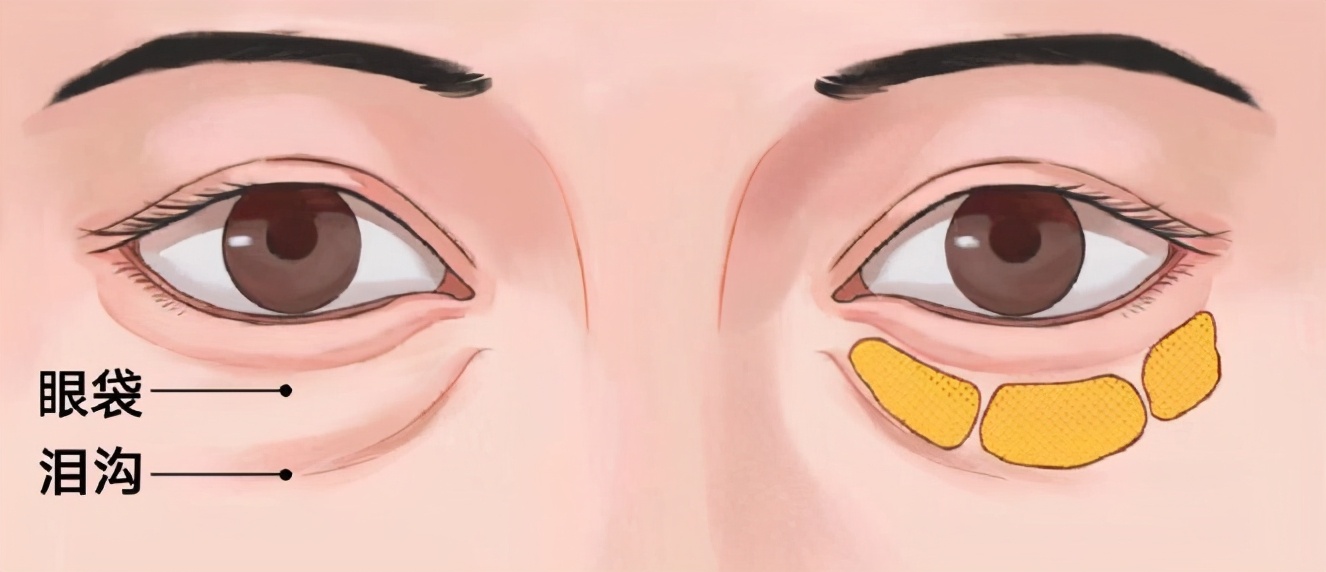 怎么样区分眼袋和泪沟,怎么区分泪沟和眼袋