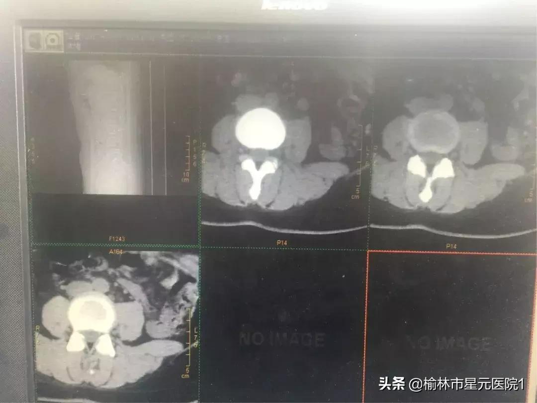 榆林市中医院治腰椎间盘突出症,榆林市治腰椎椎间盘突出