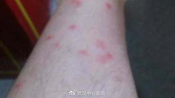 遇到这些虫子千万别拍它,提高警惕遇到这些虫子千万别乱拍