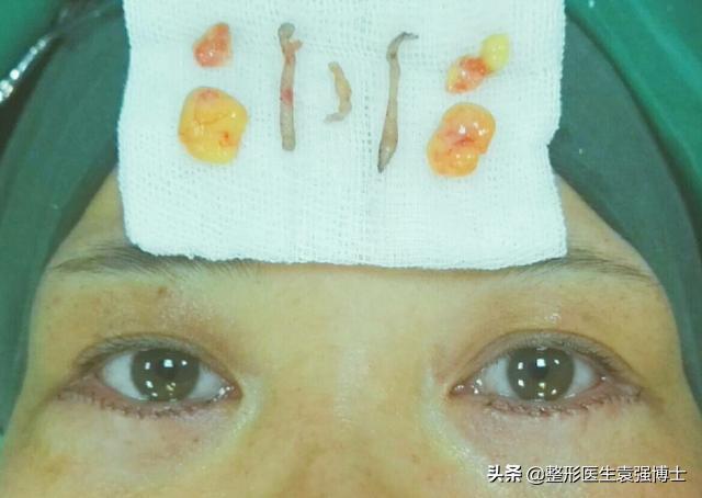 最简单最有效的祛眼袋方法,做了眼袋后悔