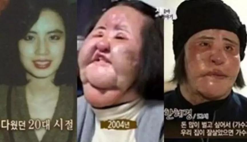 年轻的时候整容老了脸会崩吗,整过形的脸老了好不好