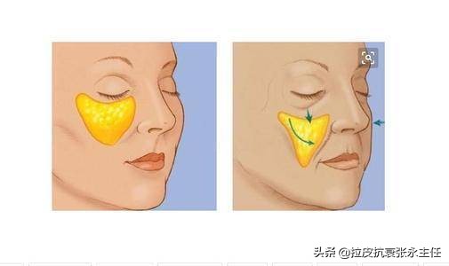 内窥镜除皱和小切口除皱,内窥镜除皱术真实案例