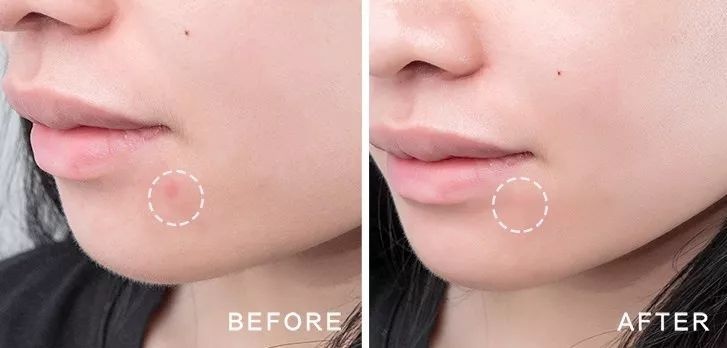 最好用最快祛痘的一款祛痘产品,老爸评测祛痘产品推荐