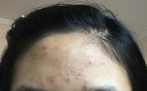 脸上老是长闭口粉刺痒痒的怎么办,10岁女孩脸上长小粉刺怎么回事
