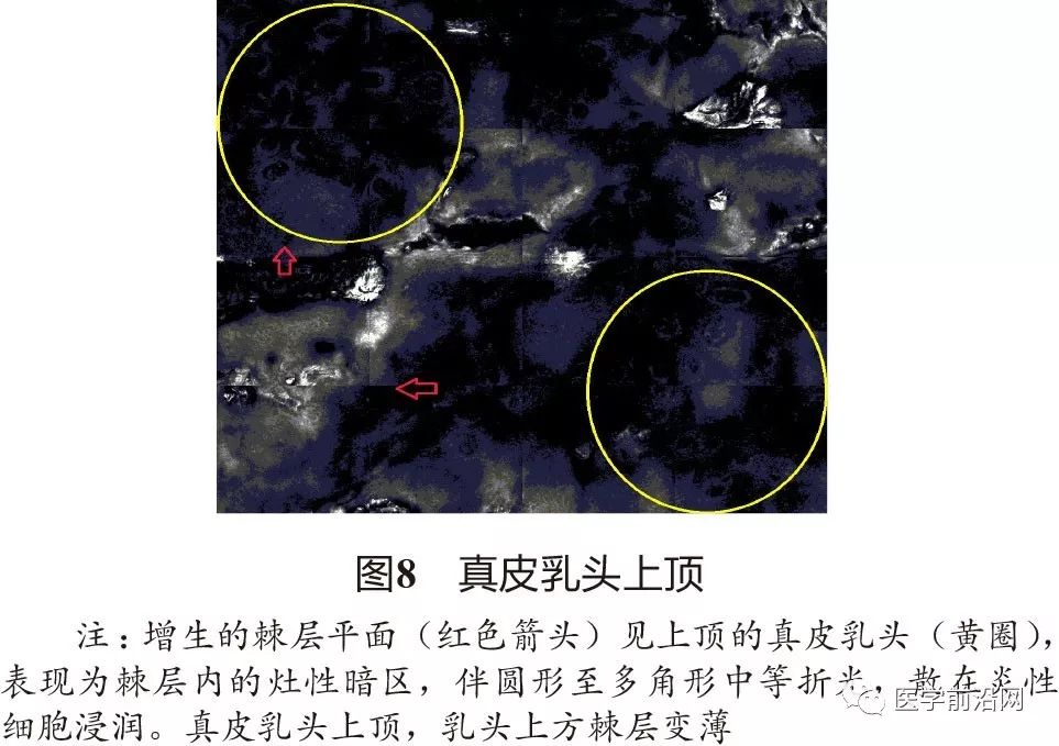 炎症性皮肤病反射式共聚焦显微镜诊断特征专家共识全文发布