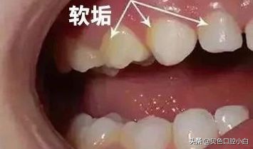宝宝牙齿黄黄的刷不干净怎么办,宝宝不爱刷牙牙齿黑了怎么办