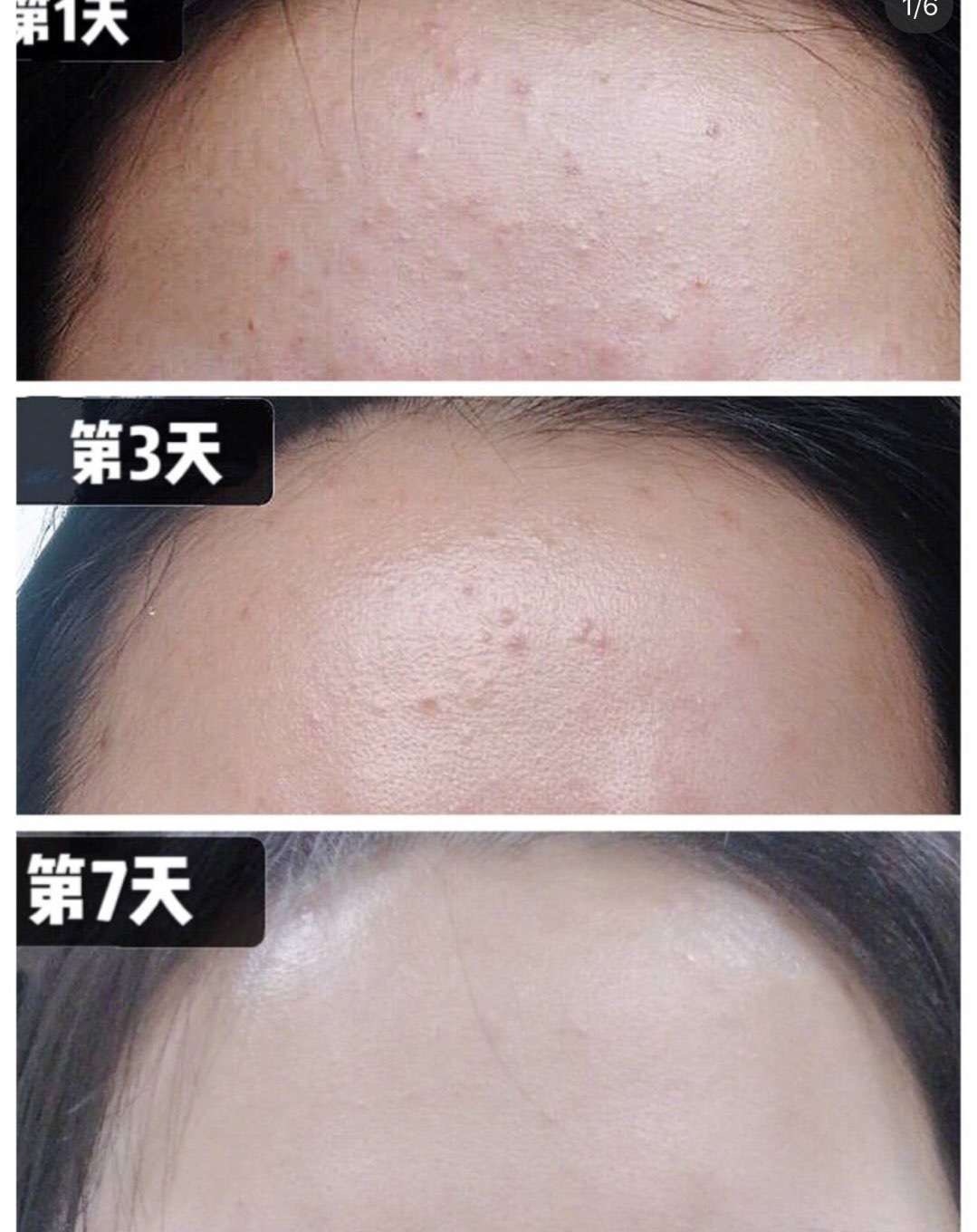 排痘效果好的药膏,祛痘排雷