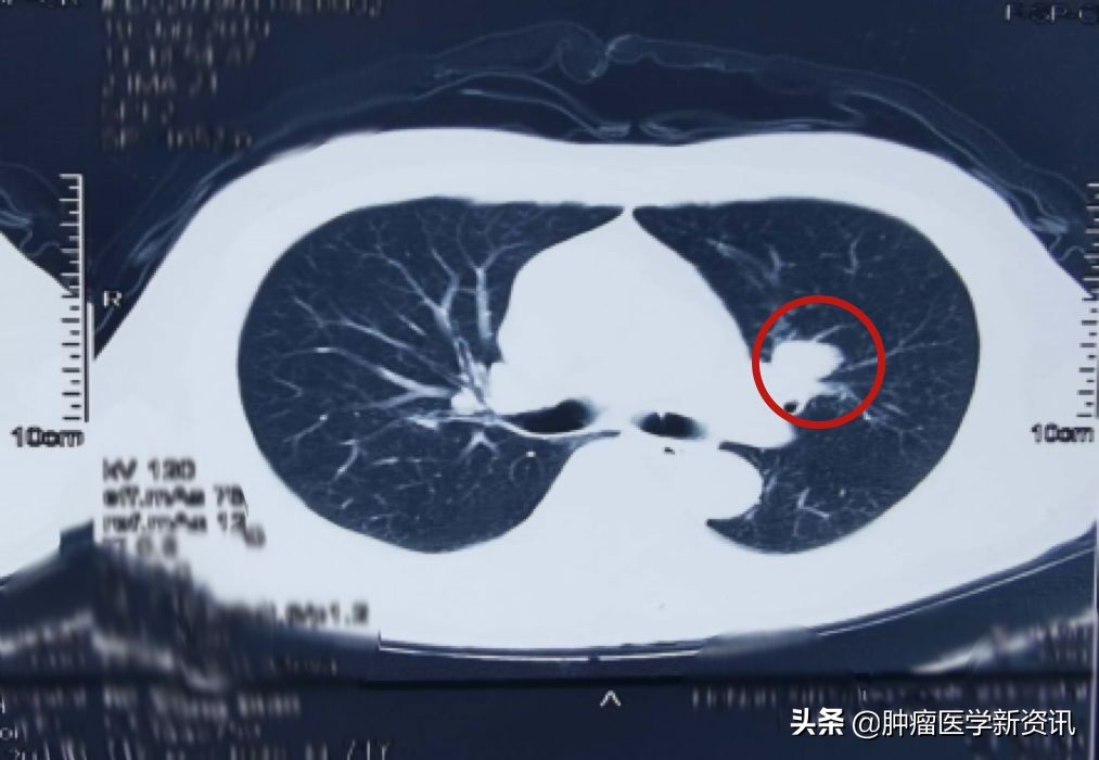 抗癌物质能治愈癌症吗,抗癌成功的几率有多大