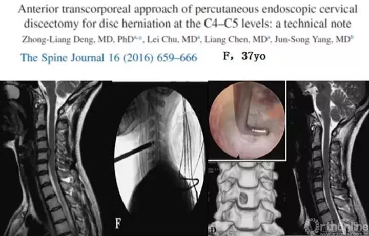 经皮腰椎间盘切除术有何优缺点,什么是经皮内镜腰椎手术