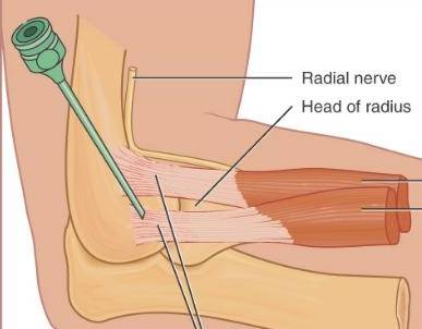 损伤疼痛，该不该打封闭呢？