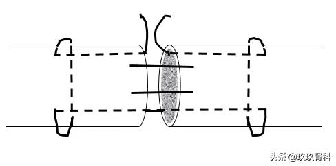 跟腱断裂的确诊方法,超详细跟腱断裂的诊断与治疗