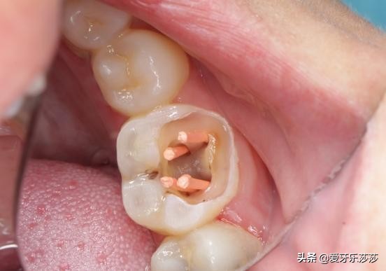 根管治疗2年后牙疼怎么办,牙疼根管治疗最后一次了