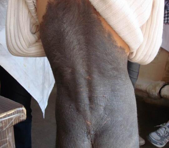 治疗兽皮痣有哪些方法,先天性巨型兽皮痣癌变几率