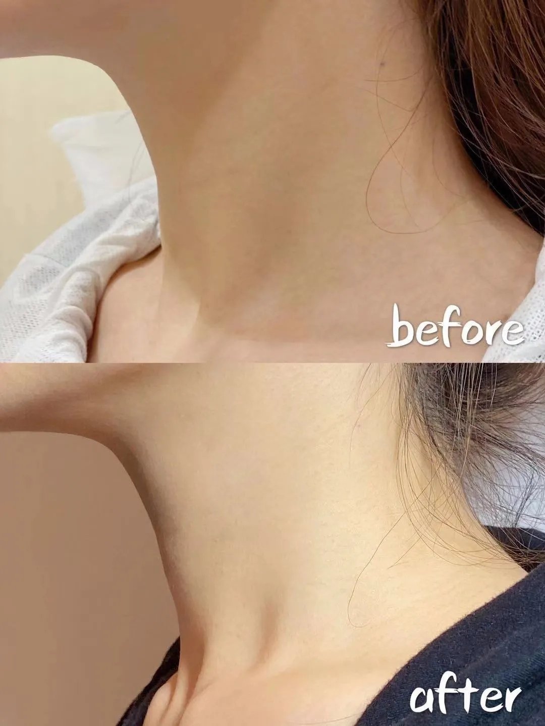 18岁脖子上有颈纹怎么按摩,18岁怎么去颈纹