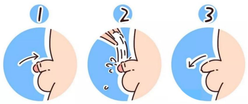 暑期孩子割包皮需要住院吗,暑期到要不要给孩子割包皮呢