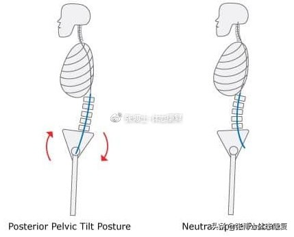 【体态矫正】骨盆后倾的形成原因与矫正训练