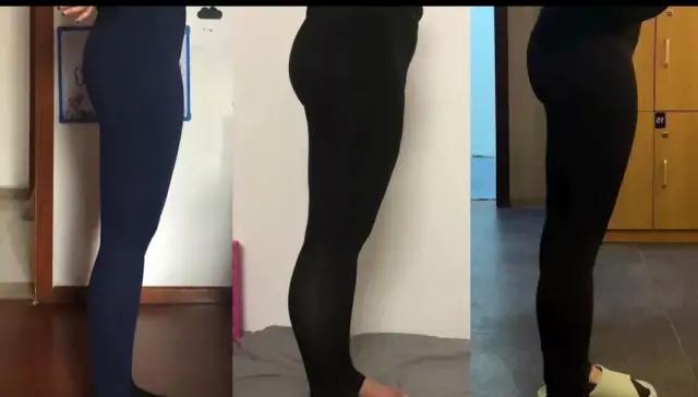 大腿前侧凸起一块肉怎么回事,大腿前侧突出什么样子