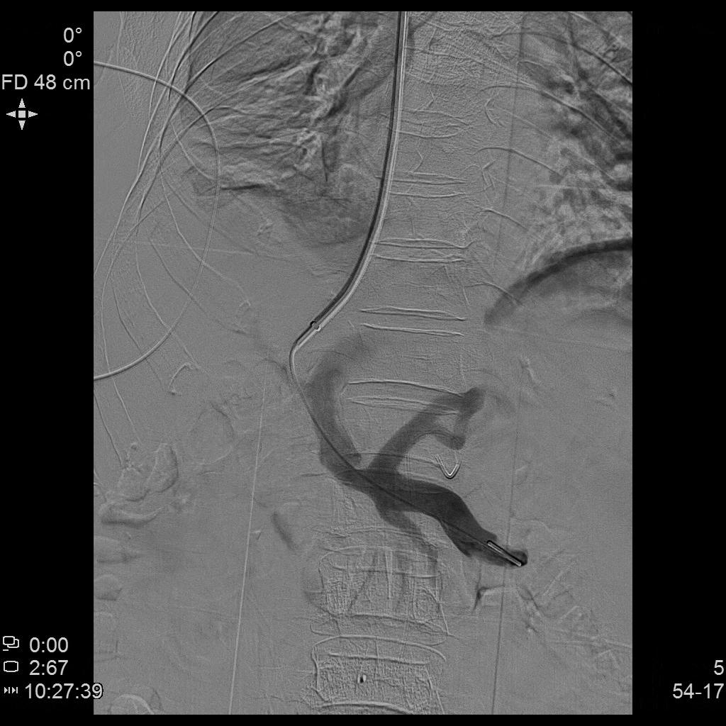 肝硬化引起门脉高压消化道出血,肝硬化消化道大出血怎么治疗