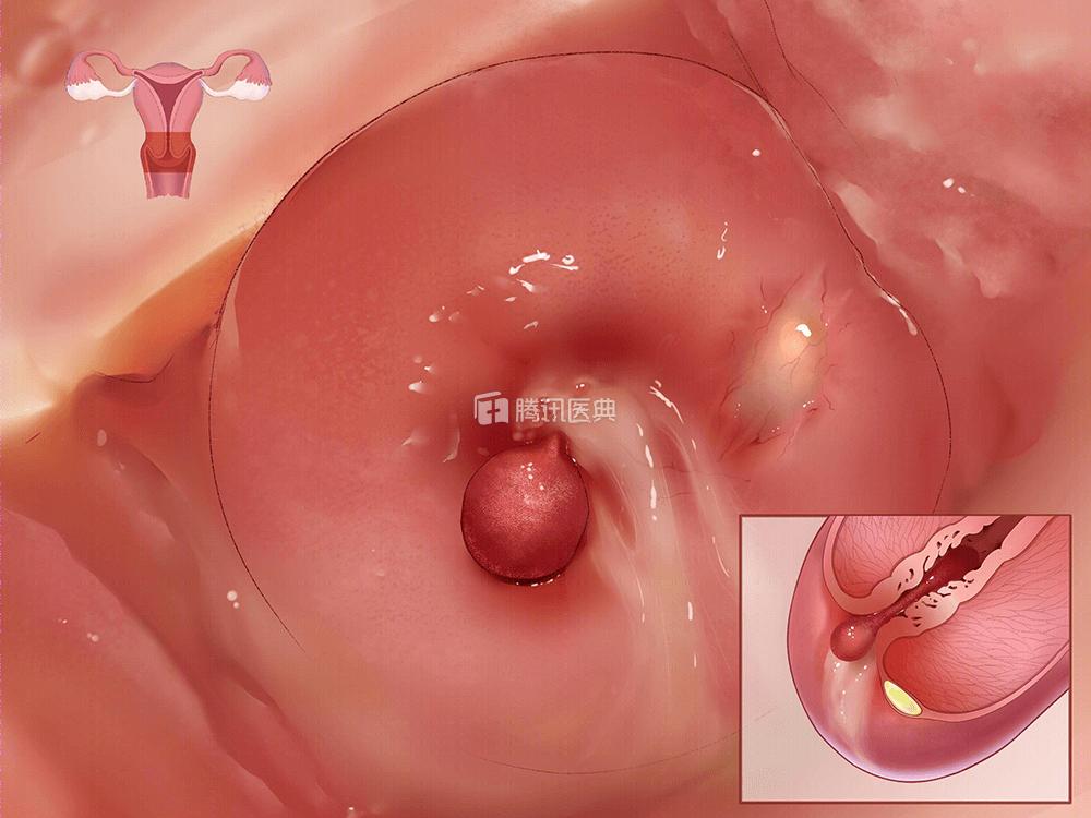 妇科炎症反复发作医生说尽快怀孕,妇科炎症老是反复男的怎么治疗