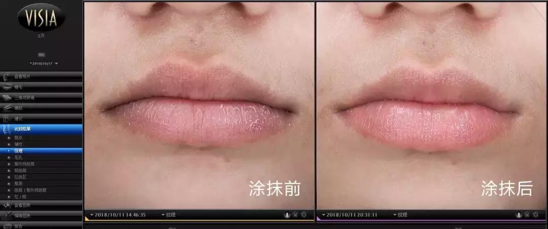 唇炎唇干起皮用什么唇膏,干唇救星唇膏