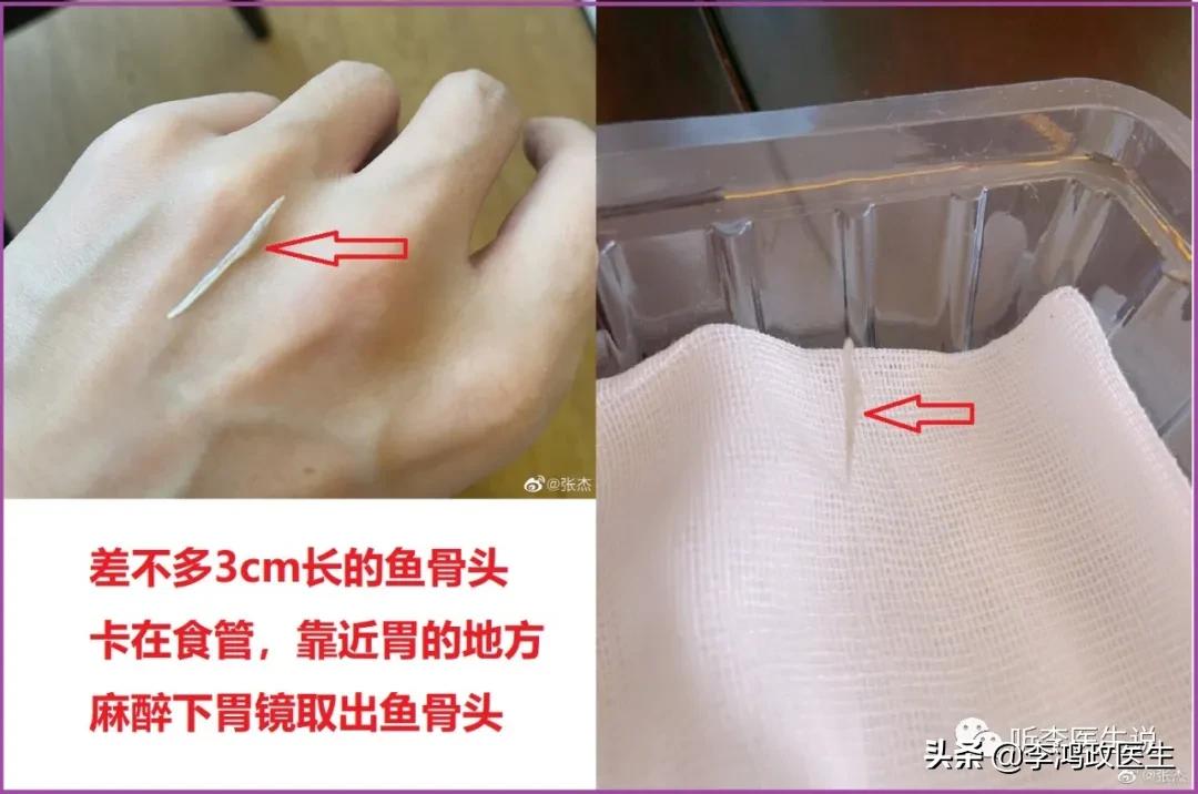 呕血死亡的人最终诊断,关于患者突然呕血死亡病例分析