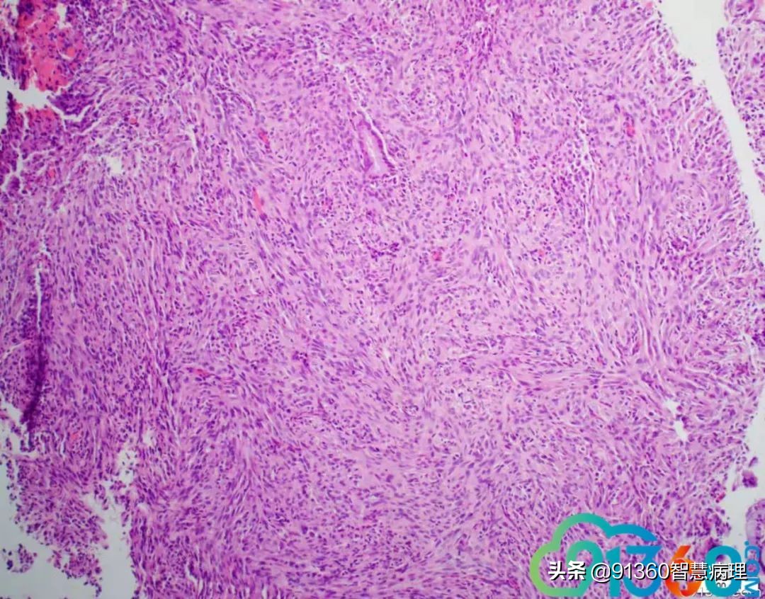 宫颈腺癌silvaa型严重吗,宫颈腺癌silvab型复发率高吗