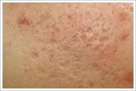 最简单的方法可以快速祛除痘印,如何有效且健康的祛除痘印