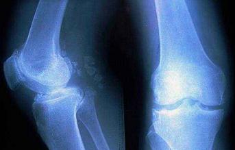 骨质增生和骨关节炎补钙有用吗,骨刺骨质增生关节炎用什么药