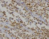 菁讲:你所不知道的横纹肌肉瘤