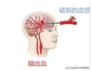 中国哪个医院治疗脑出血最好,河南治疗脑出血的最好方法