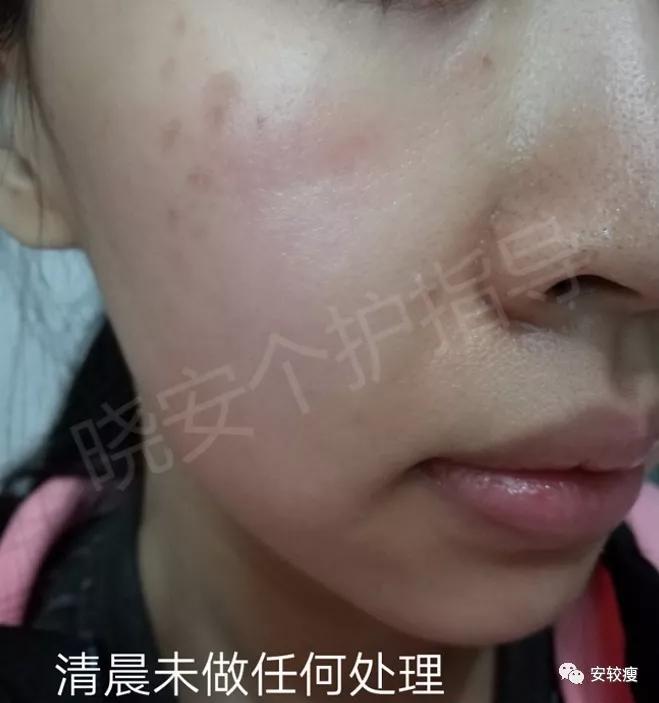 皮炎疹子干燥泛红,秋冬皮肤泛红发烫