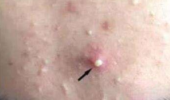 脸上长痘痘有白色脓包选什么药膏,脸上长痘痘怎么除螨