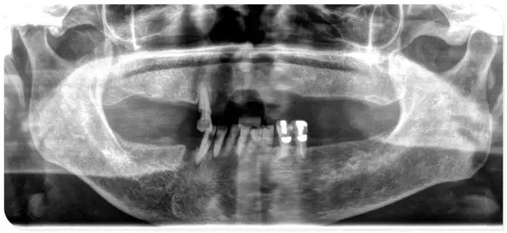 79岁老人看牙经历：不敢拔牙、不想种牙、不戴挂钩牙，怎么修复？