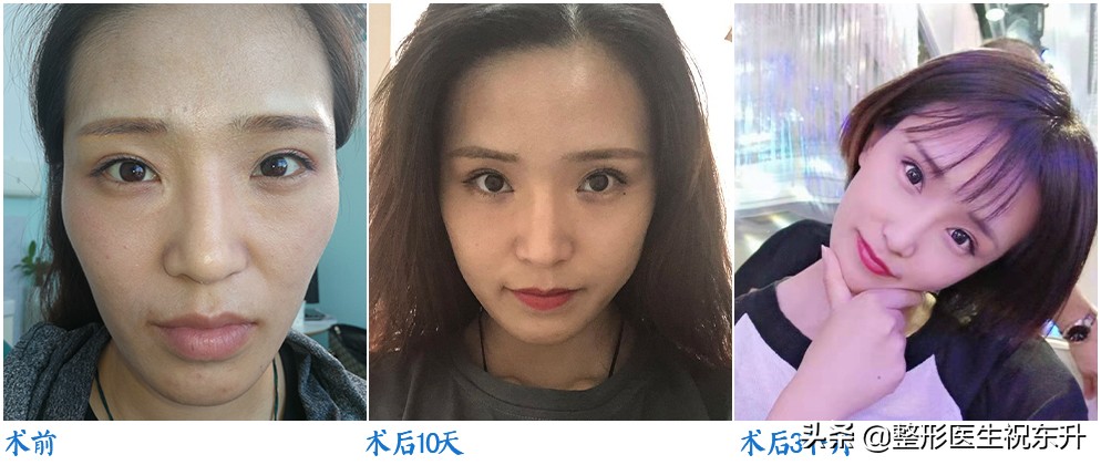 颧骨高年纪大了凹陷,颧骨高太阳穴凹陷没福气