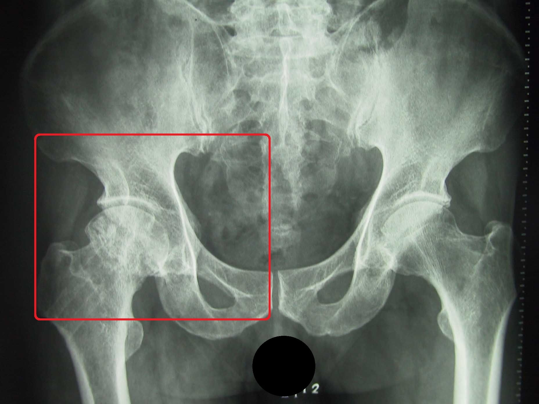 髋关节发育不良吃什么药效果最好,轻微髋关节发育不良可以不治疗吗