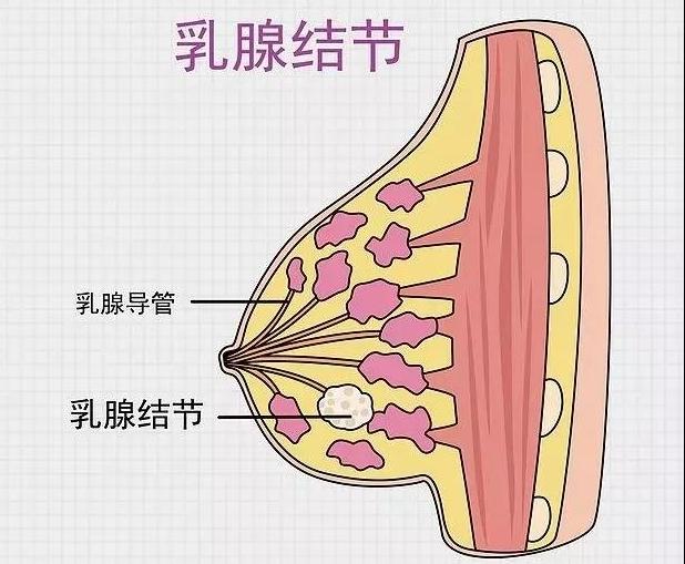 哺乳期乳房内长了一片小疙瘩,喂奶发现乳房有一个滚动的疙瘩