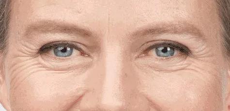 抬头纹鱼尾纹法令纹哪个更显老,抬头纹鱼尾纹法令纹颈纹一样没少