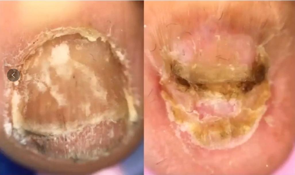 治灰指甲要验血吗,医院检查灰指甲挂号什么科