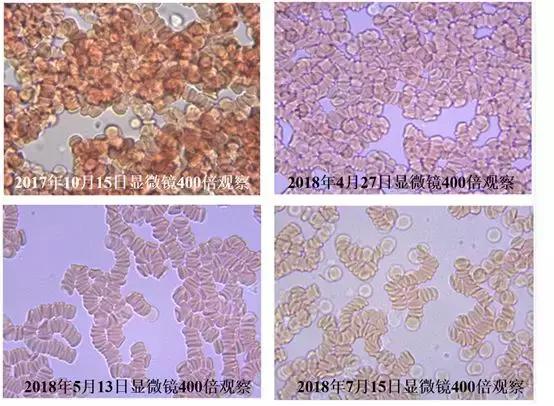 血液粘稠的病因及治疗,健康血液粘稠别小看但也别乱治