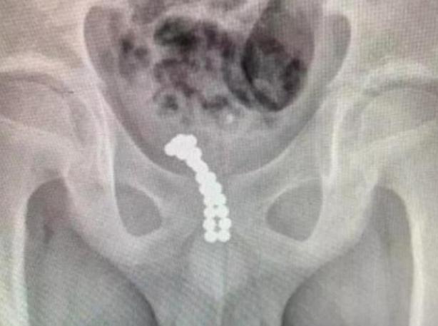 瀹濆鎬ュ繖閫佸尰,5宀佸コ瀹濆線瑁ゅ瓙閲屽涓滆タ