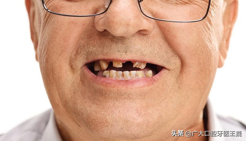 最里面烂牙残根不拔的危害大吗,成人烂牙残根不拔的危害大吗