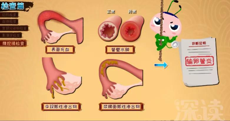 输卵管炎该如何确诊?最正确的治疗方法有哪些?良心知识科普贴