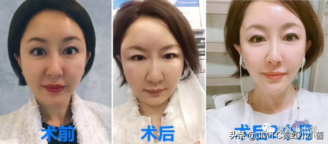 记录翻译小姐姐日本打溶脂针,肉脸变骨感脸全过程|日本医美