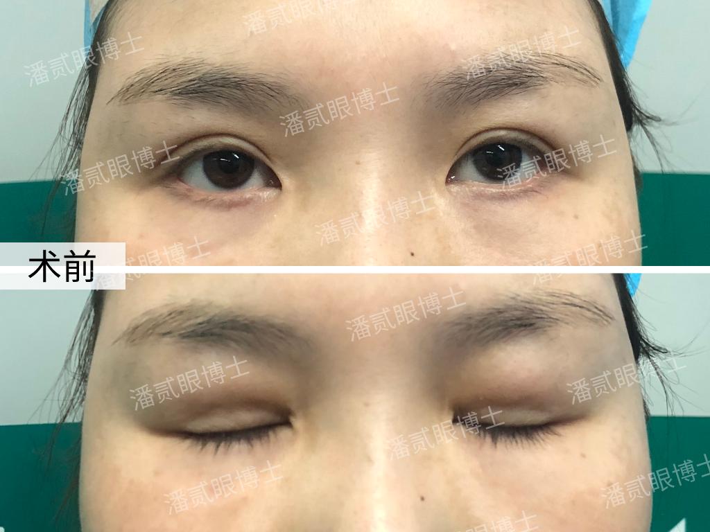 做过韩式三点双眼皮还能重新做吗,韩式三点双眼皮5年后修复