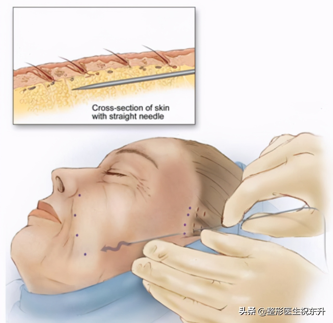 线雕隆鼻真相大揭秘,关于线雕十大热门问题解答