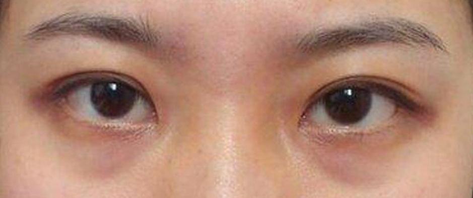 我的黑眼圈完全是熬夜熬出来的,黑眼圈是因为熬夜太多导致的吗