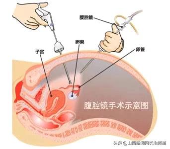 和平医院|肚脐“下刀”不留疤——和平医院开展“经脐单孔腹腔镜手术”